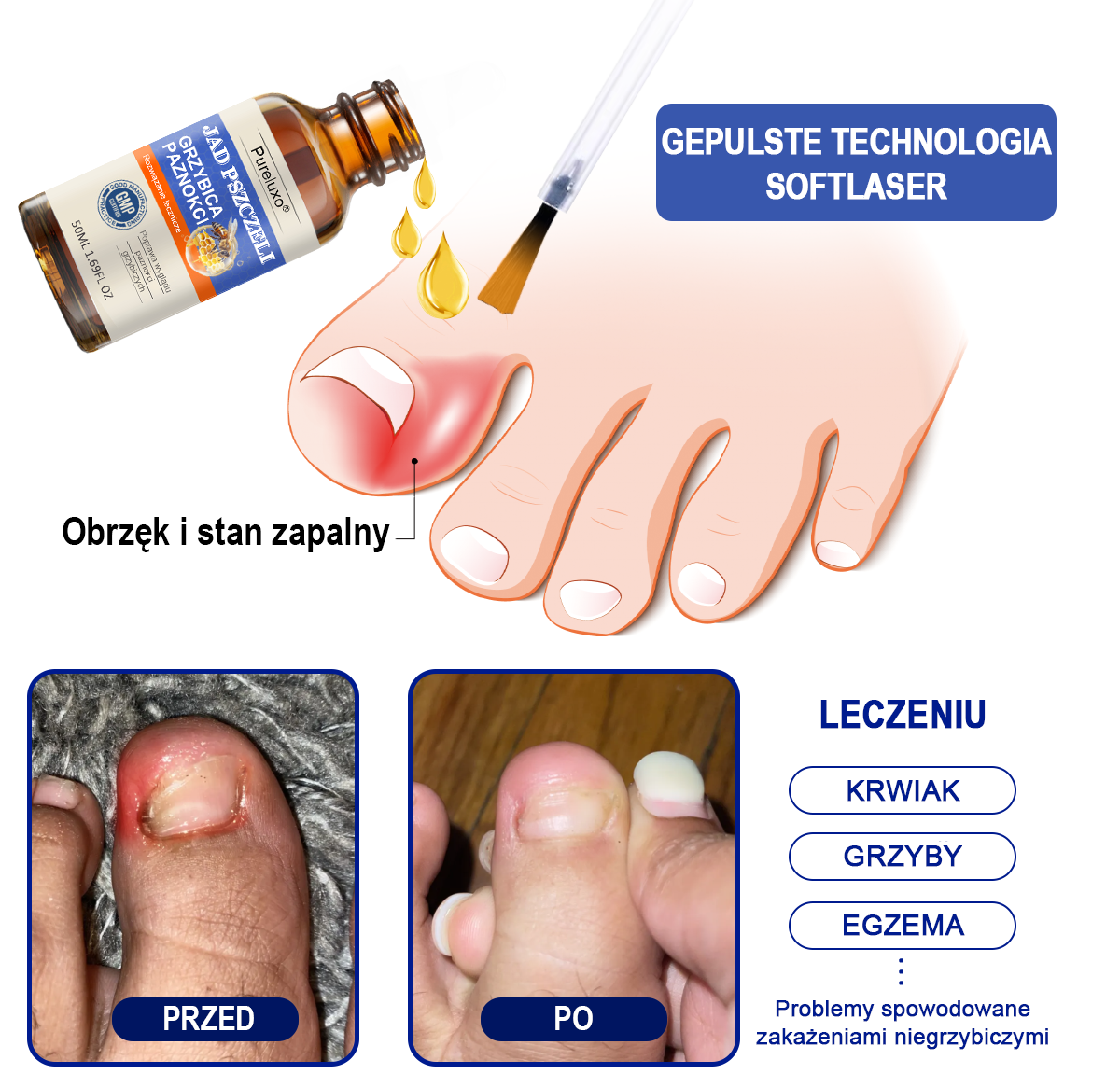 🐝👣Pureluxo® Bienengift Nagelpilz Leczenie: Całkowite rozwiązanie problemu grzybicy paznokci🌟👣👣